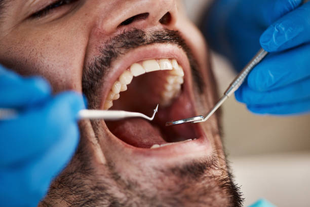 Best Knocked-Out Tooth (Avulsed Tooth) Treatment in Weigelstown, PA